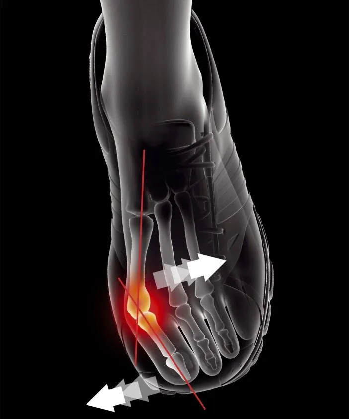 Epitact Bunion Brace / Hallux Valgus EPITHELIUMFLEX 02